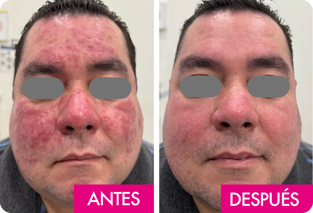 ROSACEA